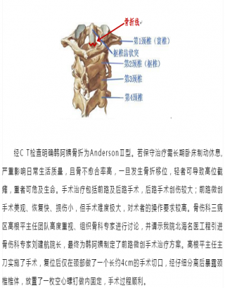挑战生命禁区 微创治疗显奇效 --北海市中医医院开展微创手术助高位颈椎骨折患者成功脱险